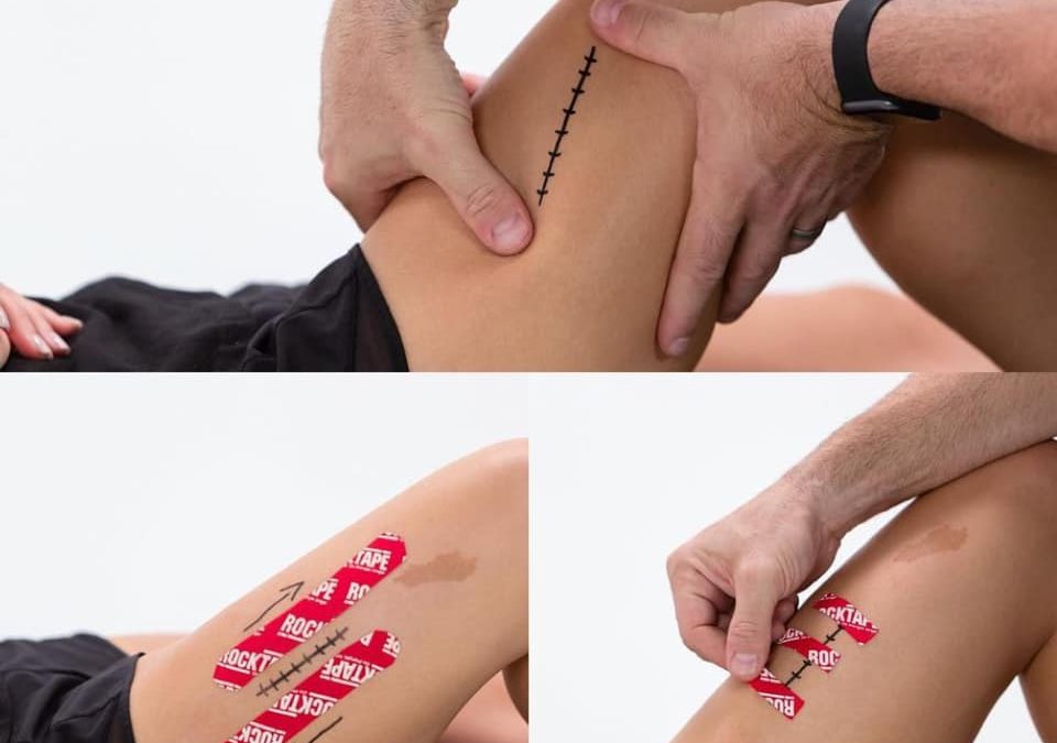 Understanding how RockTape products can be used in the management of scar tissue