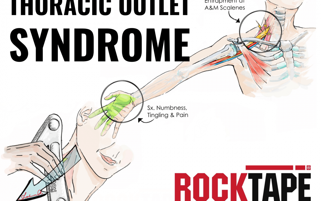 TREATING THORACIC OUTLET SYNDROME WITH IASTM